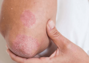 Fungal Rash, Skin Fungus Treatment