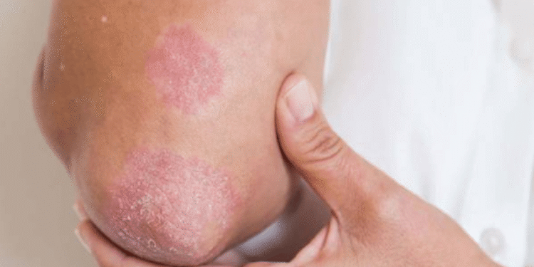 Fungal Rash, Skin Fungus Treatment