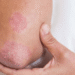 Fungal Rash, Skin Fungus Treatment