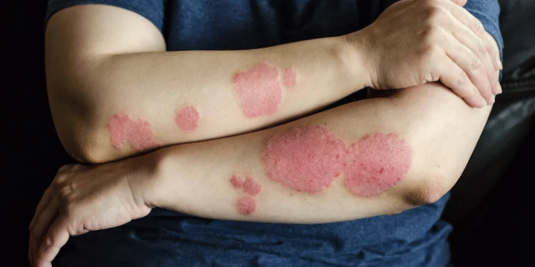 Cuidado de la psoriasis