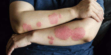 Psoriasis Care